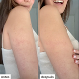 shape u c/cepillo - celulitis y queratosis pilaris