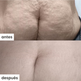 shape u c/ventosa - celulitis