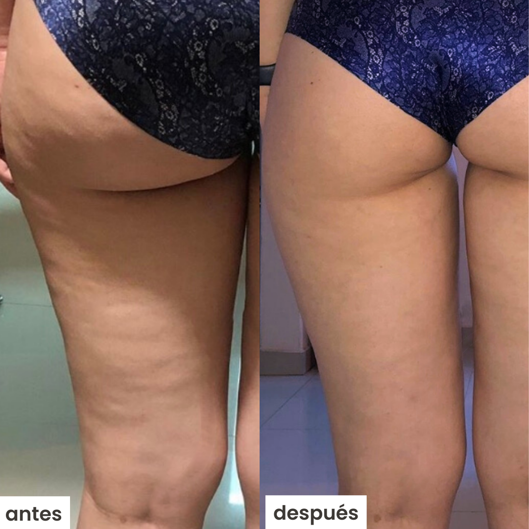 Aparato ventosa discount celulitis