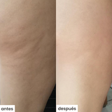 cel u - celulitis - kit c/ventosa