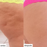 cel u - celulitis - kit c/ventosa