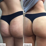 scrub u - celulitis