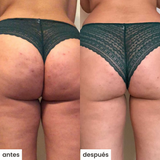 shape u c/cepillo - celulitis y queratosis pilaris